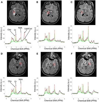 Serial Cerebral Metabolic Changes in Patients With Ischemic Stroke Treated With Autologous Bone Marrow Derived Mononuclear Cells